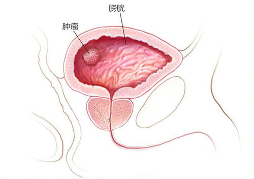 杭州御和堂中医：如何预防膀胱癌这种病好那?