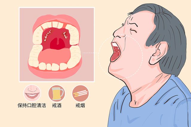 杭州御和堂中医院：长期治疗口腔溃疡会导致口腔癌吗？