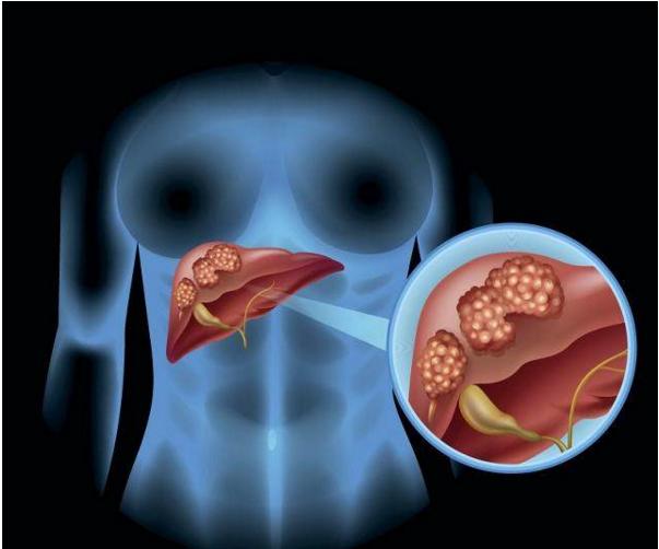 哪些病因是导致肝癌的主要因素?
