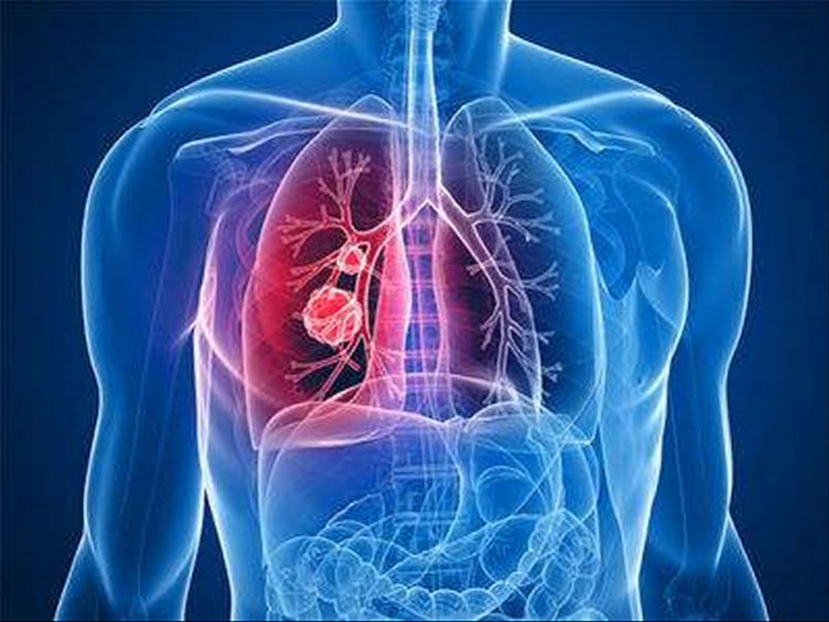 引发肺癌的发病原因有哪些？这5点要重视